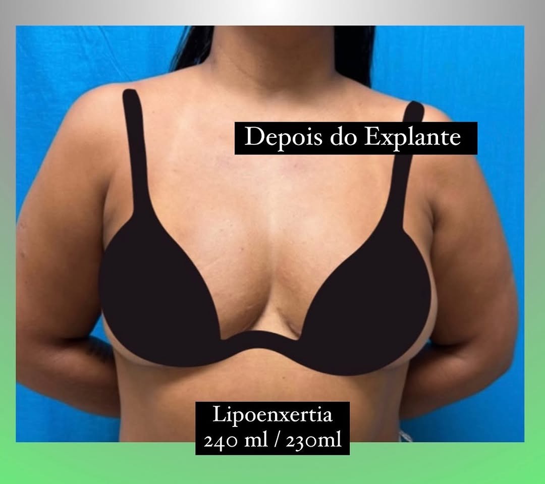 002-Antes-explante-1.jpg