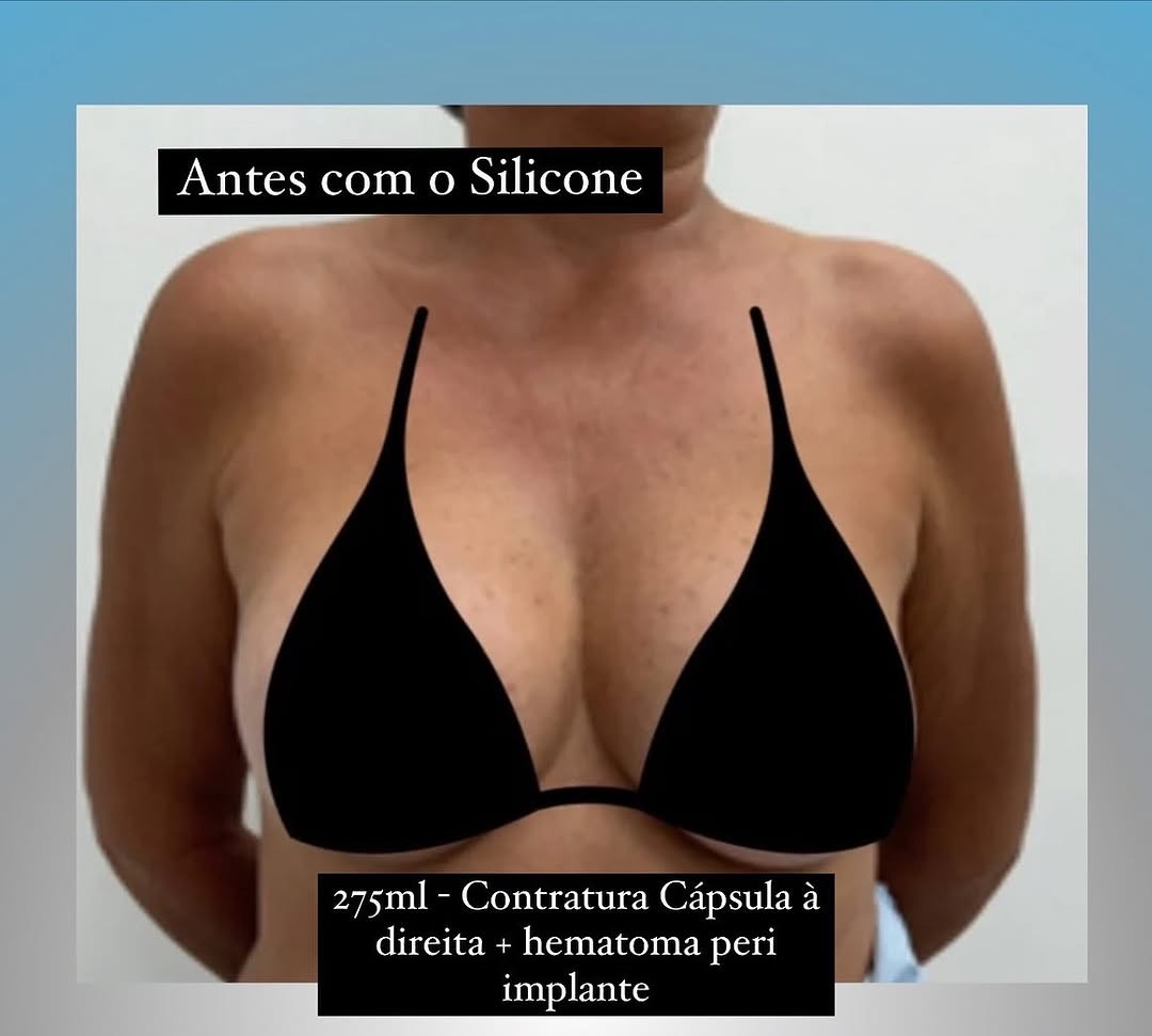 002-Antes-explante-2.jpg
