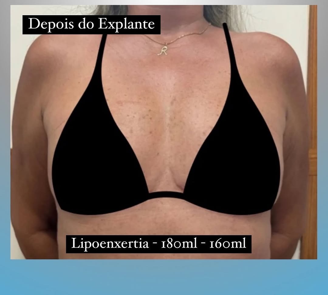 002-depois-explante.jpg