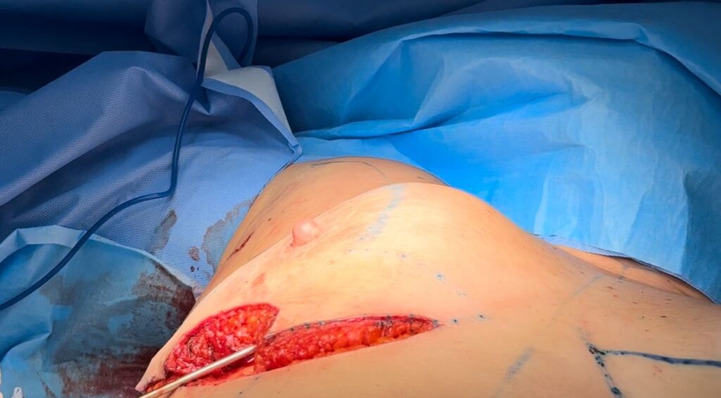 Após 70 ml de lipoenxertia