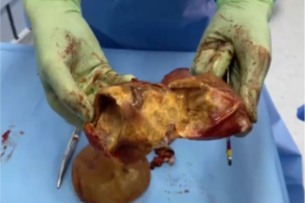 Contratura Capsular implante Silicone