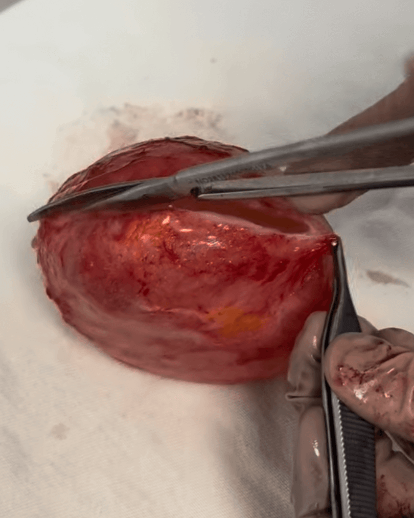 cirurgia de explante 1