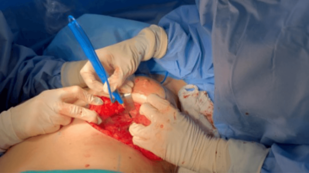 cirurgia de explante